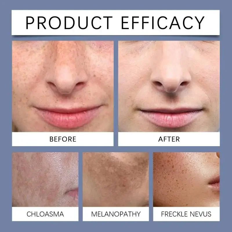 FarmStay Nicotinamide Freckle Removing Cream - LuckyShop - FarmStay